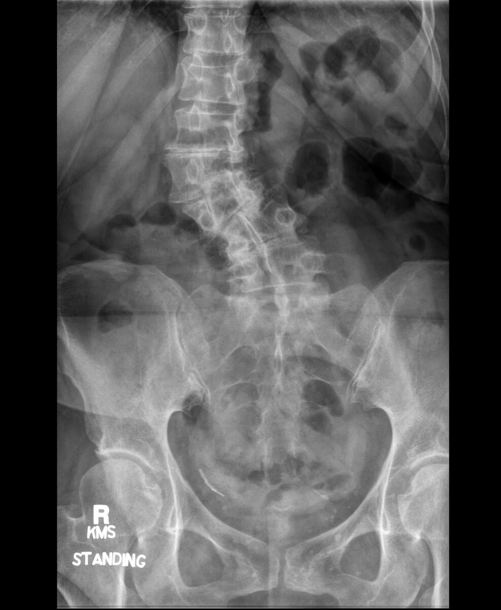 vickie-scoliosis-rolfing-case-study-xray2